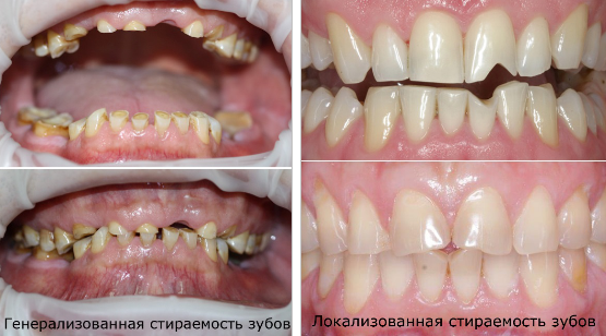 Генерализованная и локализованная стираемость зубов