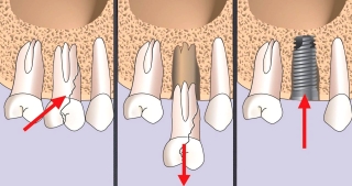Удаление зуба с одномоментной имплантацией