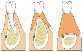 Атрофия кости альвеолярного гребня при съемном протезировании