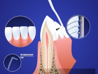 Фторосодержащие гели укрепляют эмаль зуба