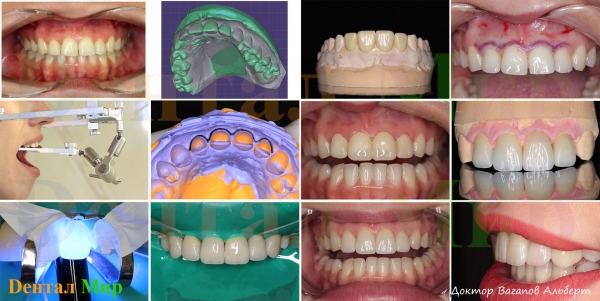 Обзорная фотография, установка шести виниров на верхние фронтальные зубы. Моделирование, WaxUp и MockUp, коррекция десны, препарирование под виниры, их изготовление и фиксация