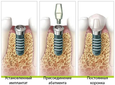 Последовательность восстановления зуба с помощью дентальной имплантации