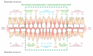 Зона, где возможна немедленная нагрузка, выделена рамкой