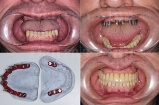 Полна имплантация и протезирование на верхней челюсти и частично на нижней