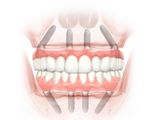  Метод имплантации "All-On-4"