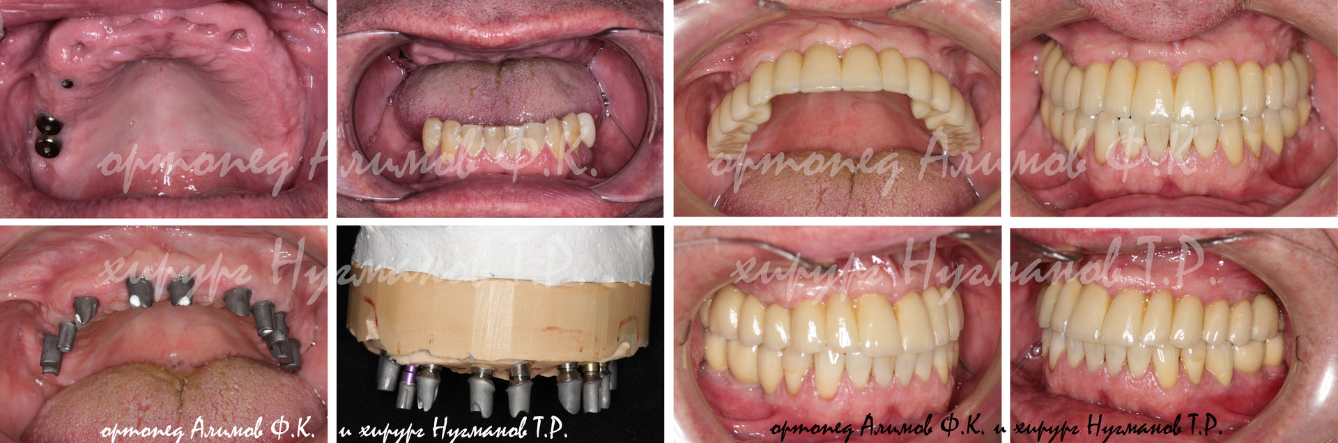 Полная имплантация зубов