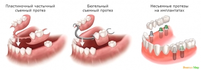 Принципы фиксации частичного съемного протеза, бюгельного протеза и протезов с опорой на имплантаты