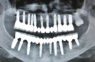 Рентгенологическое исследование после классической имплантации