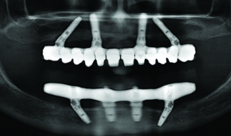 Рентгенологическое исследование после имплантации All-on-4