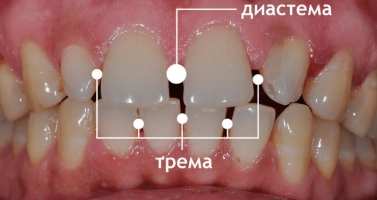 Диастема и трема