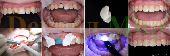 Фотографии работы по установке керамического винира e.max, изготовленной по технологии CEREC. Работа выполнена за один прием стоматолога