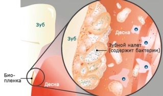 Образование зубного налета под десной