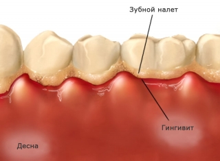 Гингивит. При его лечении чаще применяется комплексная чистка зубов