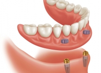 Условно несъемный протез на 2х мини-имплантатах. Закрепляется с помощью фиксирующих колпачков
