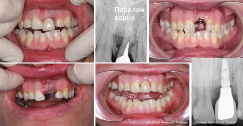 Сломанный под корень передний зуб был удален, проведена одномоментная имплантация и установлена полностью керамическая коронка