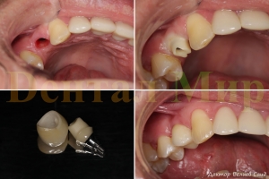 Коронка из диоксида циркония на индивидуальном абатменте. Трасокклюзионная фиксация