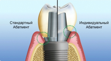 Стандартный и индивидуальный абатменты