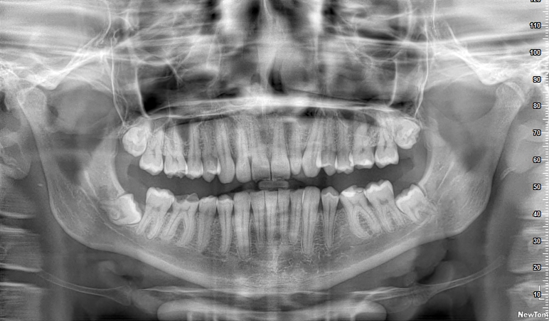 Ортопантомограмма (ОПТГ)