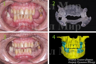 Определение прикуса дает направление установки имплантатов
