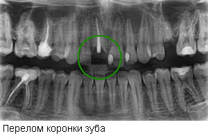 Снимок проблемного зуба