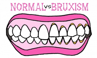 Проблемы зубов при бруксизме
