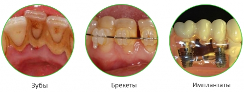 Ультразвуковая чистка нужна для естественных и искусственных зубов, и особенно при ношении брекетов