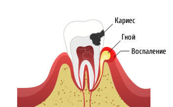 Возникновение периостита (флюса)