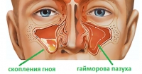 Распространение в гайморовы пазухи