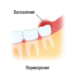 Перикоронарит. Развитие раздражения