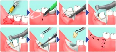 Лечение перикоронарита с удалением зуба мудности