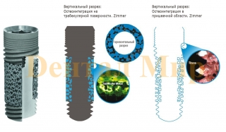 Результаты исследований по остеоинтеграции Zimmer