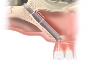 Скуловые имплантаты Nobel Zygoma