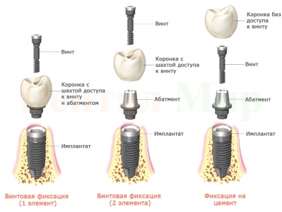 Два типа винтовой фиксации и фиксация на цемент