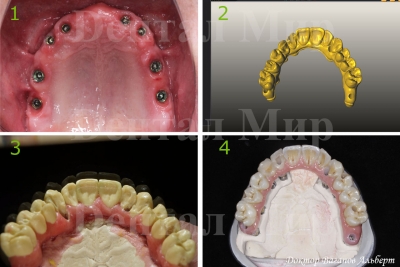 Полный несъемный протез на винтовой фиксации