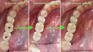 Этапы закрытия шахты винта