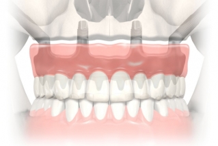 Скуловые имплантаты Nobel Zygoma. Концепция All-on-4