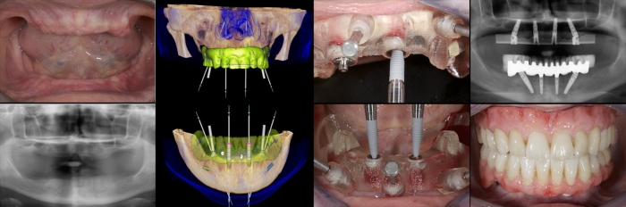 Пример полного протезирования. Технология All-on-4 