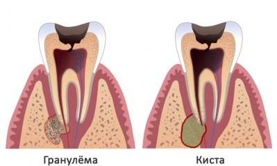 Воспаление переходит в глубь кости, в которой начинают происходит изменения