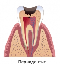 Воспаление пульпы выходит из апекса зуба в периодонтальную связку и надкостницу