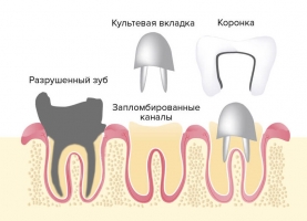 Принцип применения культевой вкладки