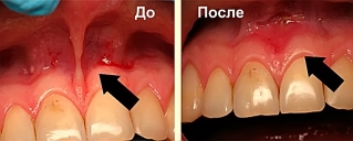 Иссечение уздечки верхней губы