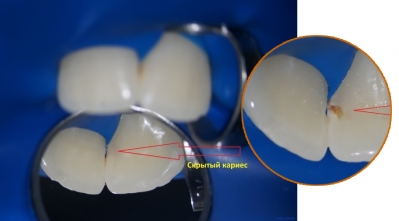 Скрытый кариес на контакте при увеличении