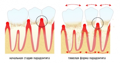 Стадии пародонтита
