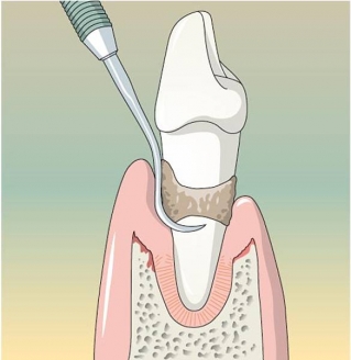 Закрытый кюретаж зубодесневых карманов
