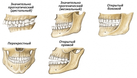 Виды паталогического прикуса