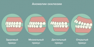 Аномалии окклюзии