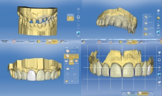 Моделирование коронки в среде CAD