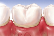 Воспаленные десны при гингивите