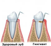 Пародонтальные карманы при гингивите - до 3мм