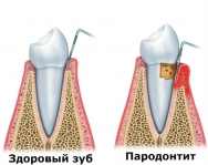Пародонтальные карманы при пародонтите -  6 мм и более